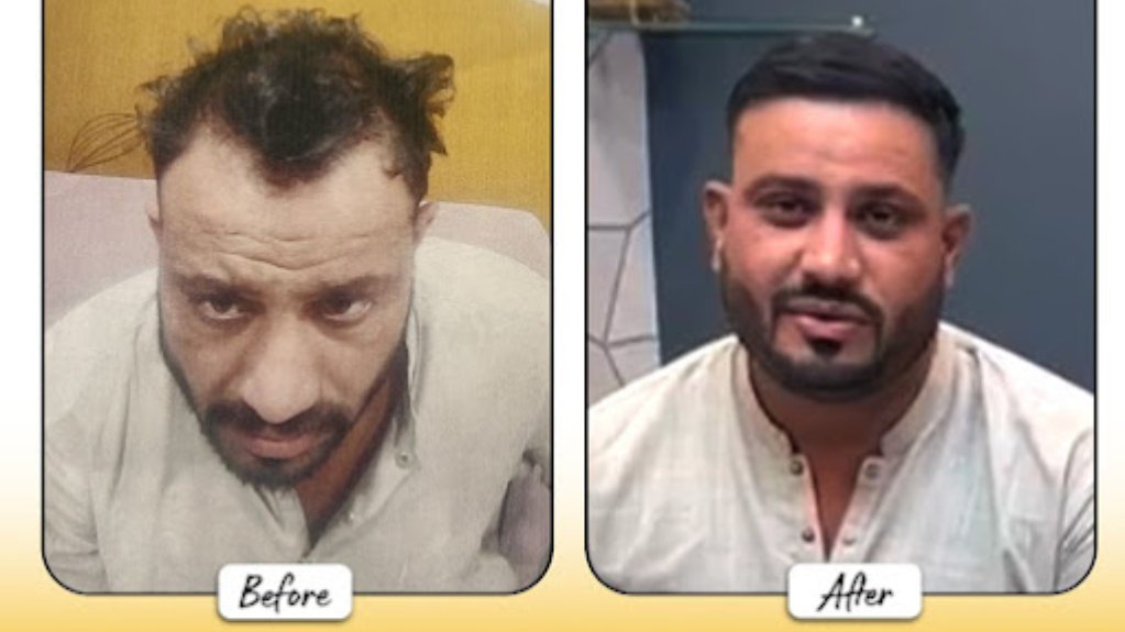 Before and after hair restoration