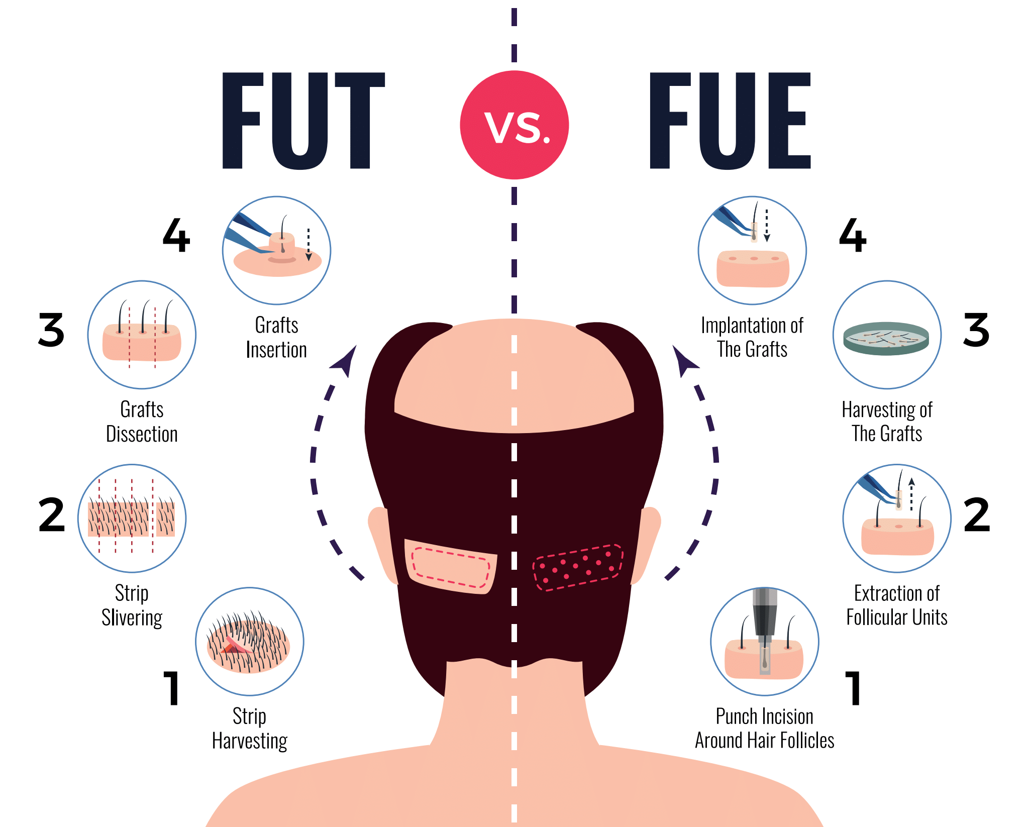 FUE vs FUT Comparison