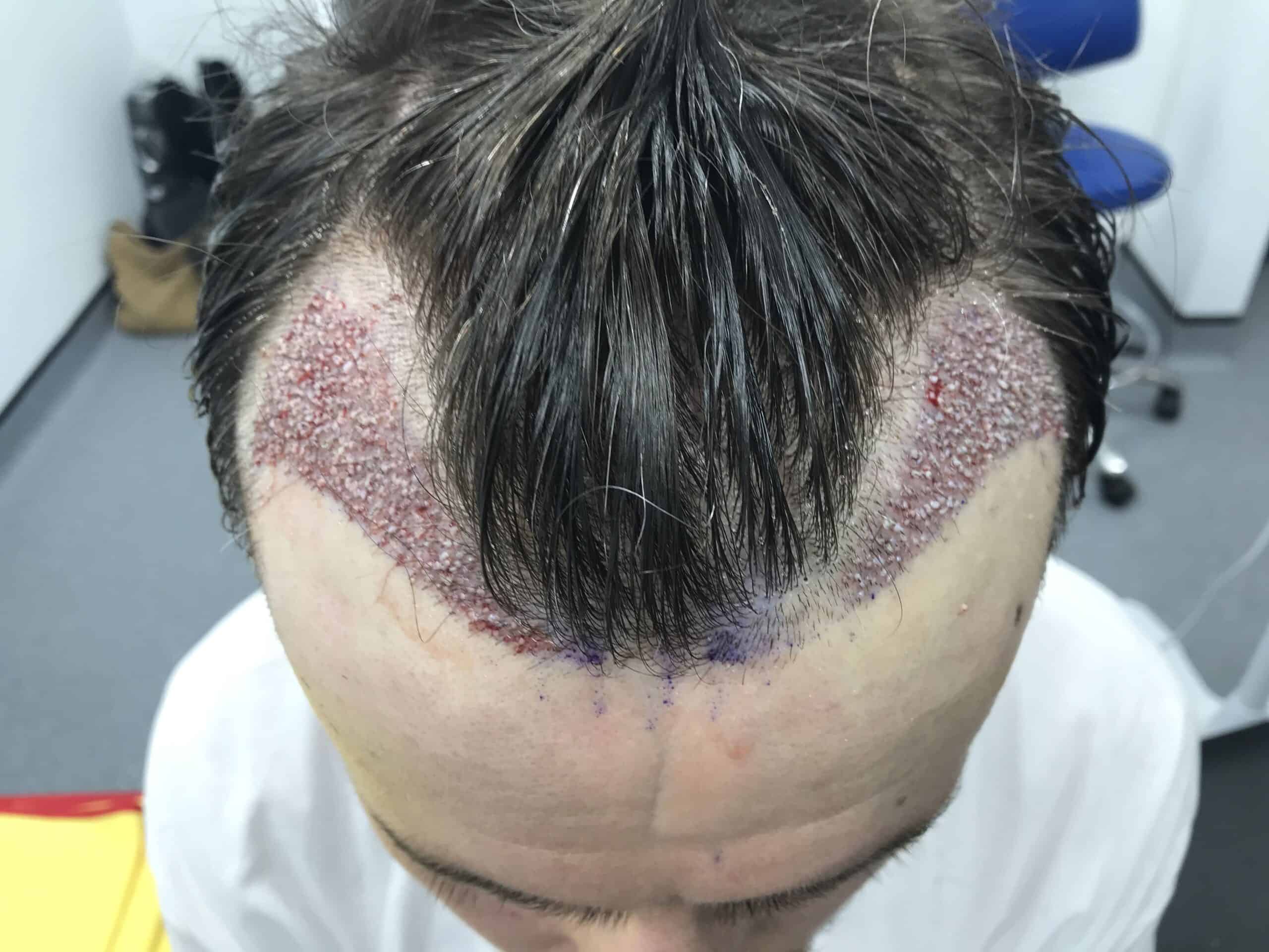 Hair Transplant Surgeon
