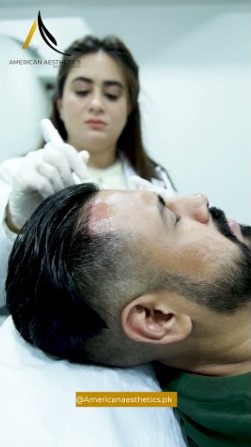 After Hair Transplant